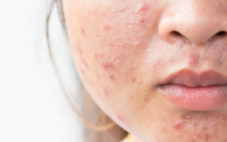 Các Phương Pháp Hữu Hiệu Để Ngăn Ngừa Mụn Trong Kỳ Kinh Nguyệt