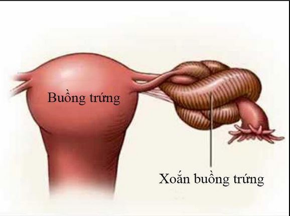 Những Dấu Hiệu Cảnh Báo Xoắn U Nang Buồng Trứng Ở Phụ Nữ Trẻ