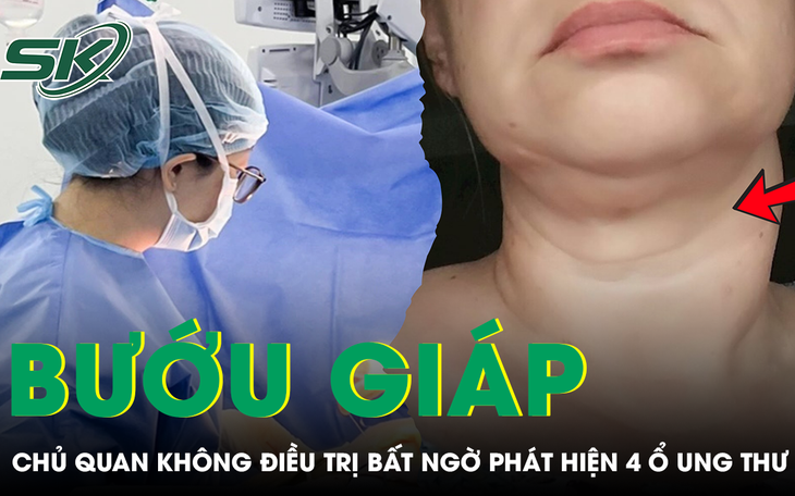 Bướu giáp không điều trị