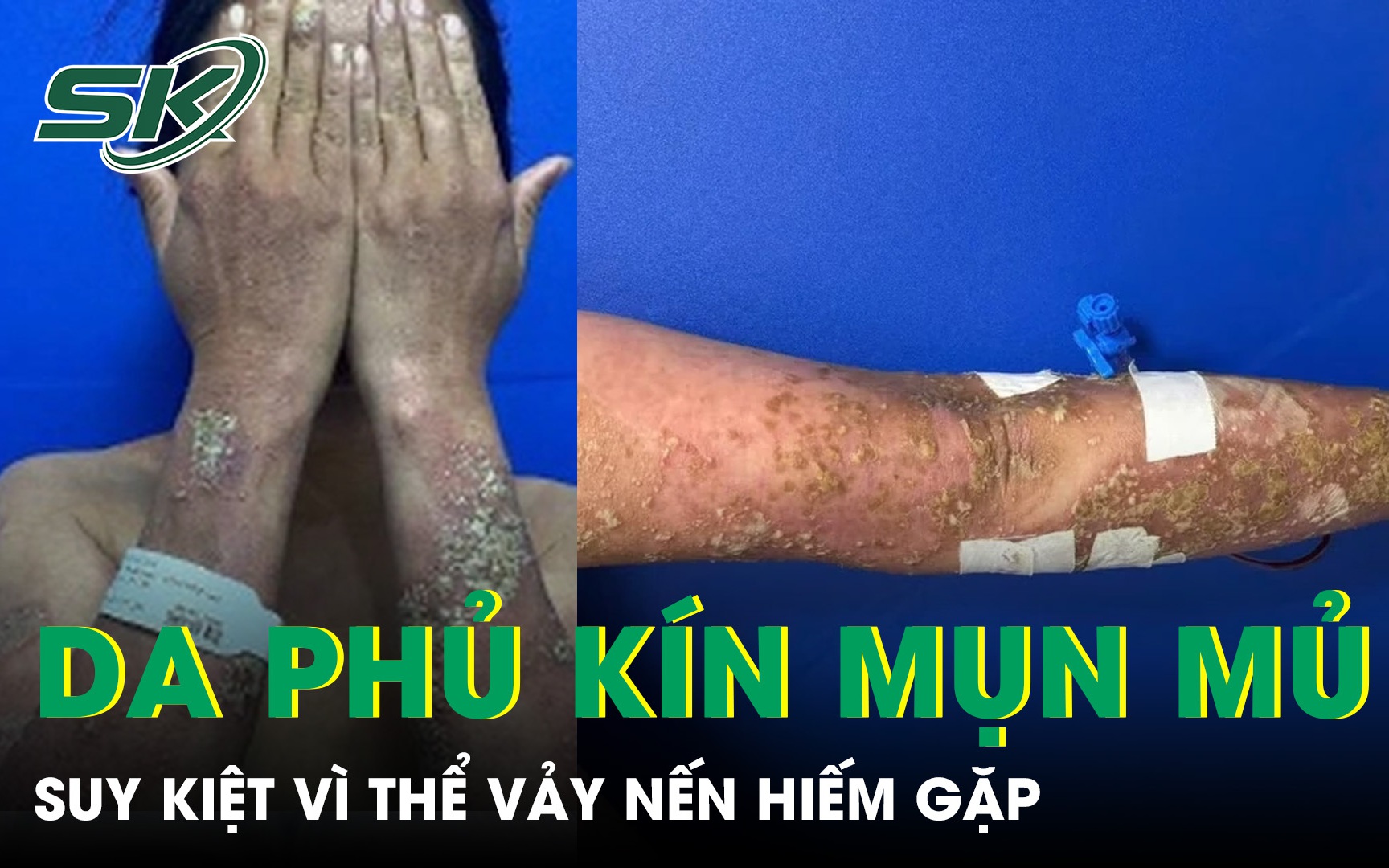 Nguy Cơ Tổn Thương Da Nặng Do Tự Ý Sử Dụng Thuốc Điều Trị Vảy Nến