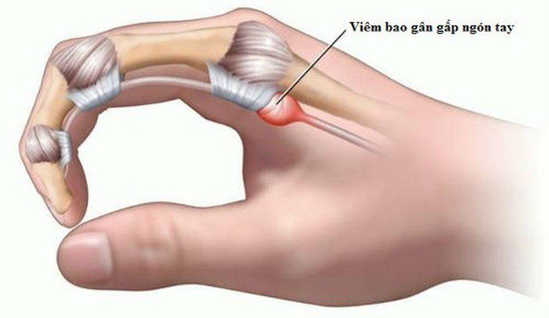 Cảnh Giác Với Viêm Gân Gấp Ngón Tay: Dấu Hiệu và Giải Pháp