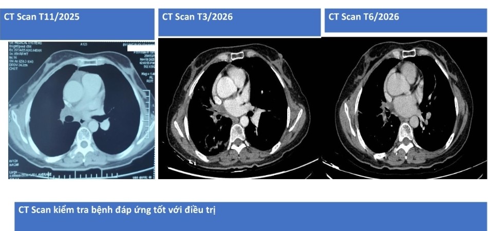 Hình ảnh CT Scan của bệnh nhân trước và sau điều trị. Ảnh: BVCC.