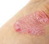 Cách ctDNA Ảnh Hưởng Đến Quyết Định Hóa Trị Sau Phẫu Thuật Ung Thư Đại Tràng