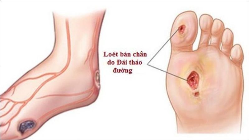 Tê bì bàn chân ở người tiểu đường: nhận biết sớm và cách bảo vệ chân