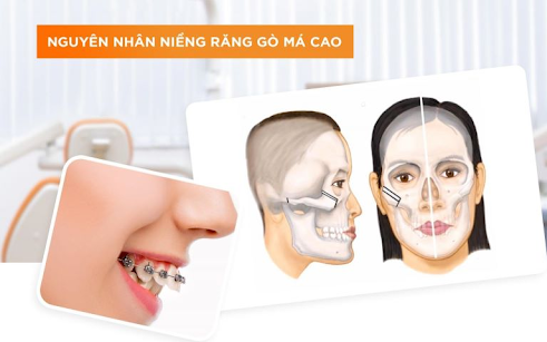 Giải Quyết Vấn Đề Hóp Má Khi Niềng Răng: Nguyên Nhân và Giải Pháp Hiệu Quả