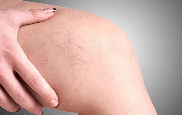 Ba Biến Chứng Nguy Hiểm Của Suy Giãn Tĩnh Mạch Chân Bạn Cần Biết
