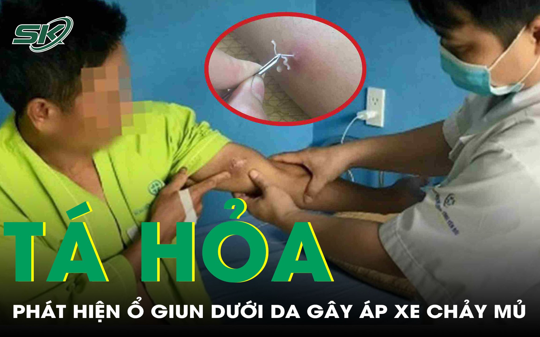 Việt Nam Ghi Nhận Ca Thứ 44 Nhiễm Giun Rồng: Những Điều Cần Biết
