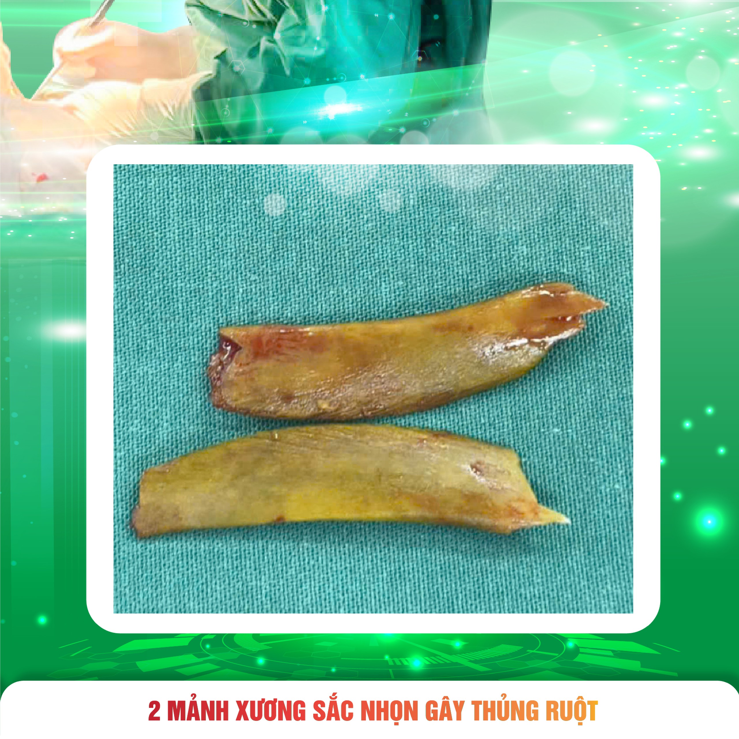 Người đàn ông hai lần thủng ruột vì cùng một nguyên nhân- Ảnh 3.