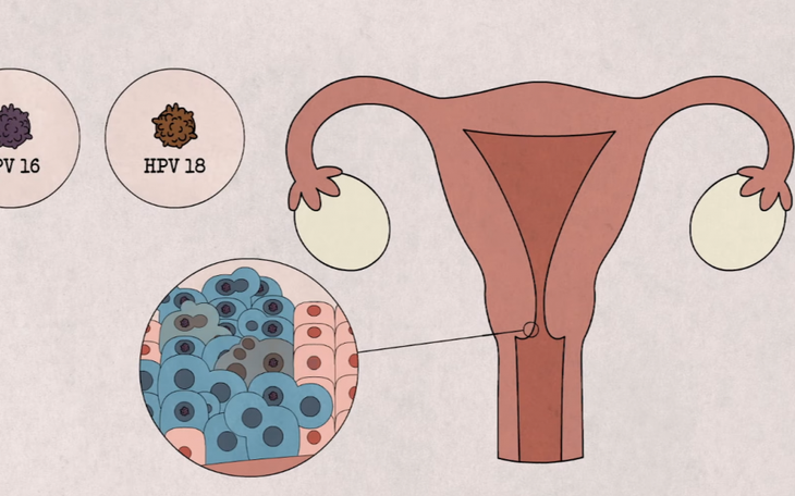 Tiêm phòng HPV rồi có cần khám tầm soát ung thư cổ tử cung nữa không? - Ảnh 3.