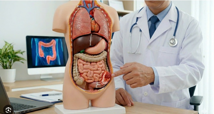 Thời Gian Sống Của Bệnh Nhân Ung Thư Đại Tràng: Những Yếu Tố Quyết Định