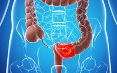 Giải Quyết Tình Trạng Bí Tiểu ở Người Cao Tuổi: Cách Tiếp Cận Hiệu Quả