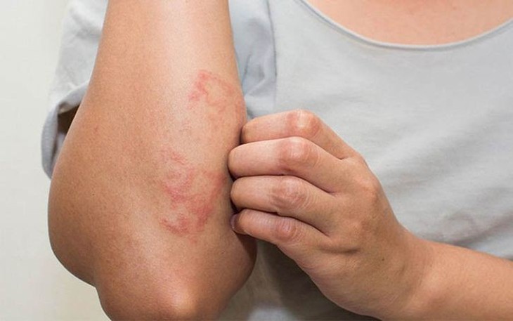 6 thói quen giúp kiểm soát viêm da cơ địa, giảm nguy cơ tái phát- Ảnh 1.