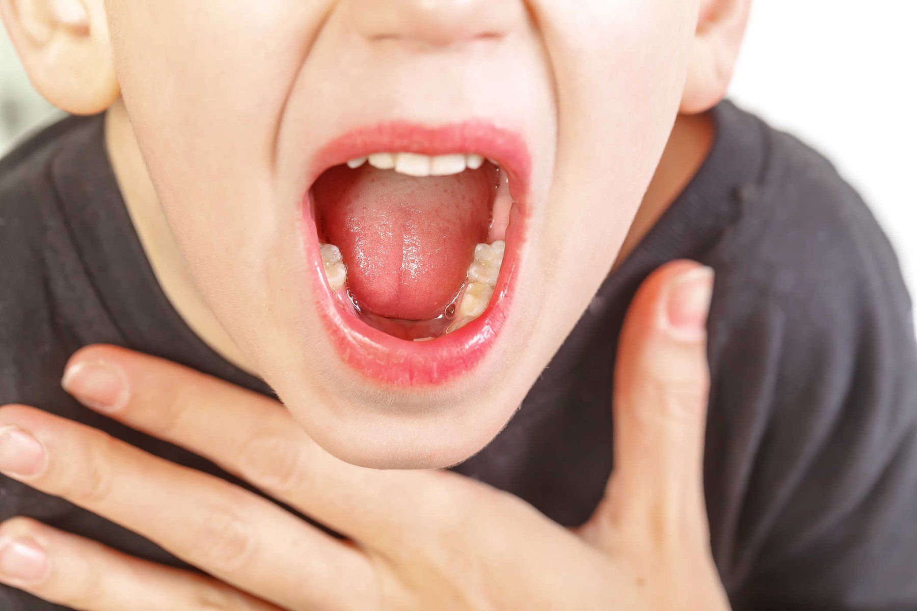 Dấu hiệu viêm VA ở trẻ: nhận biết sớm, hậu quả và khi cần can thiệp