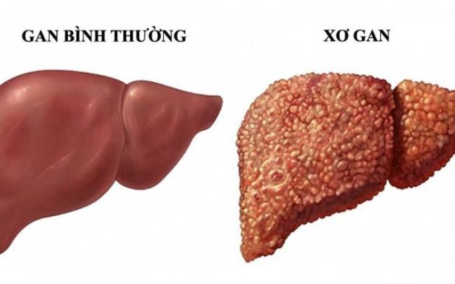 7 Dấu Hiệu Bạn Không Nên Bỏ Qua Khi Gan Bị Tổn Thương