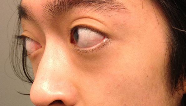 Lồi mắt do Basedow: nhận biết, xử trí và khi nào cần can thiệp